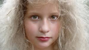Uncombable hair syndrome