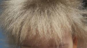 uncombable hair is a “recessive” genetic characteristic